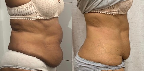 Expert-byJ : Amincissement Et Beauté : Cryolipolyse Marseille 8ème, Centre d'Amincissement à Marseille 08